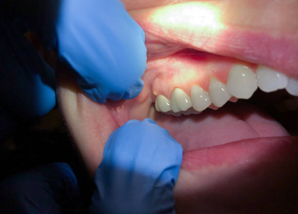 Best Emergency Treatment for Oral Infections in Kaysville, UT